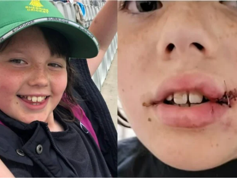 The Hundred में 11 साल की बच्ची साथ हुआ दर्दनाक हादसा, गेंद लगने के बाद मुंह पर लगे टांके